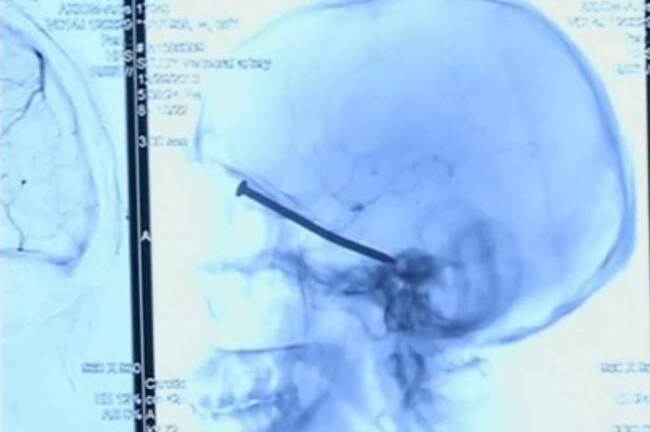 Thoát chết thần kỳ sau khi chiếc đinh 8 cm đâm vào hộp sọ 